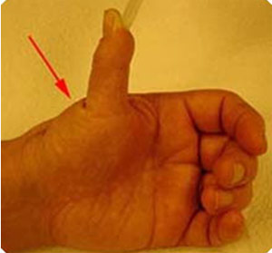 симптоми артрозу великого пальця руки