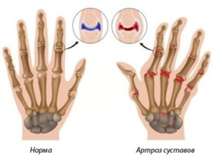 як лікувати суглоби пальців рук