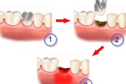 лікувати ясна після видалення зуба