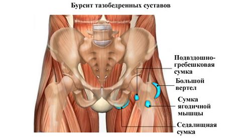 як лікувати вертельную бурсит