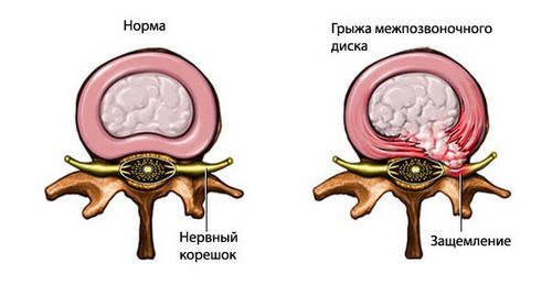 як лікувати спину якщо защемило нерв