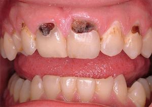 карієс між зубів