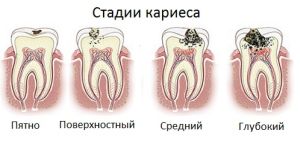 лікування карієсу на передніх зубах