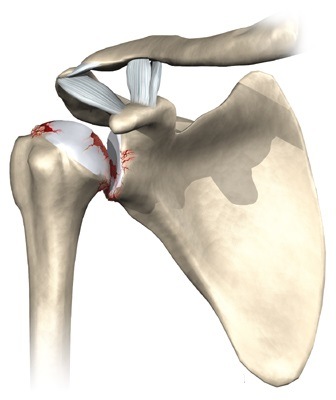 лікувати деформуючий артроз плечового суглоба