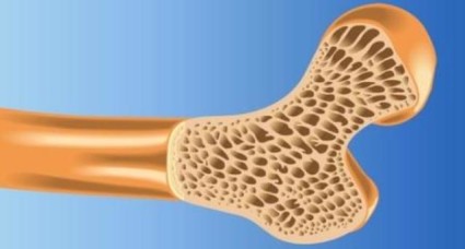 дифузний остеопороз хребет лікування костя такий стопа кисть колінний остеоартроз рука поперековий відділ тазостегновий гомілковостопний куприк симптом Інволютивних плечової чоловік правильно харчуватися суглоб як при