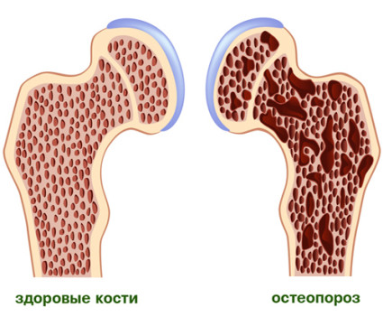 як лікувати остеопороз рук