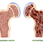 дифузний остеопороз хребет лікування костя такий стопа кисть колінний остеоартроз рука поперековий відділ тазостегновий гомілковостопний куприк симптом Інволютивних плечової чоловік правильно харчуватися суглоб як при