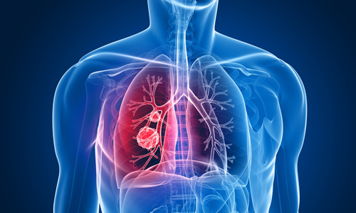 як лікувати пухлина легенів
