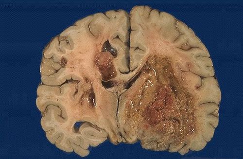 глиобластома головного мозку