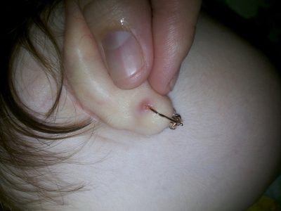 ніж лікувати вуха після проколу