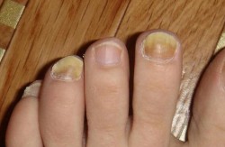 лікувати грибок нігтів народними засобами