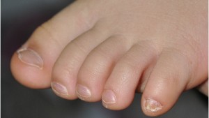 як вилікувати грибок нігтів у дитини