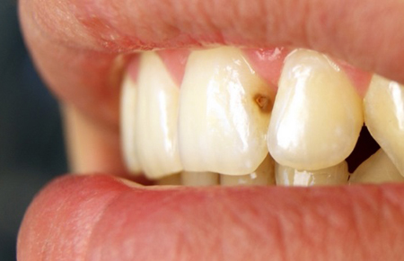 як лікувати карієс на передніх зубах