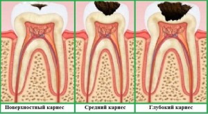 як вилікувати карієс зубів