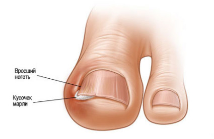як лікувати врослий ніготь на нозі видалення операція мазь тампонування
