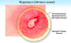 як лікувати фурункул після операції