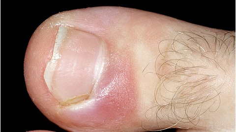 як вилікувати хворі нігті на ногах