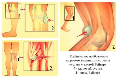 ніж лікувати кісту під коліном