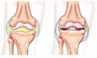 як лікувати артроз суглобів