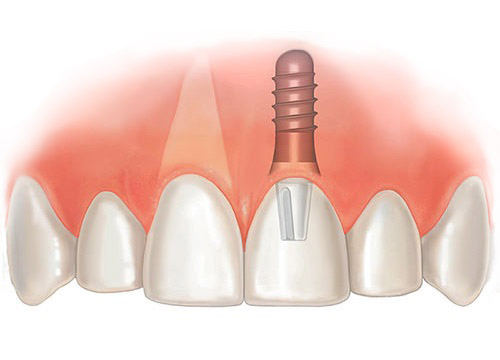 як лікувати карієс між передніми зубами