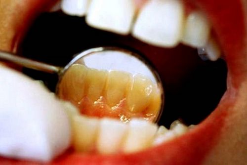 як лікувати карієс між передніми зубами