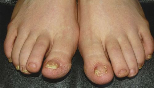 таблетки від грибка нігтів на ногах