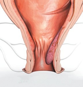 лікувати внутрішній геморой