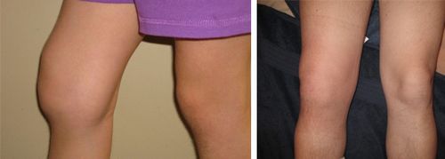 чи можна вилікувати артроз колінного суглоба