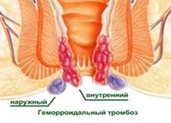 як лікувати гострий геморой