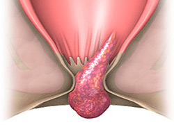 як лікувати гострий геморой