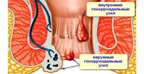 як лікувати гострий геморой