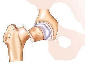 остеопороз стегно тазостегновий суглоб причина лікування діагностика