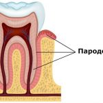 як лікувати ясна від пародонтозу