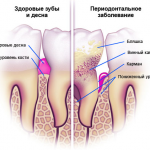 як лікувати ясна від пародонтозу