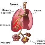 як лікувати запалення легенів у вагітних