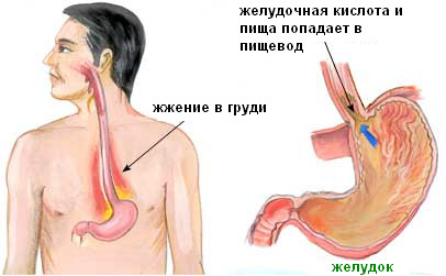 симптоми печії