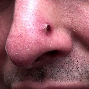 як лікувати червоні прищі на носі