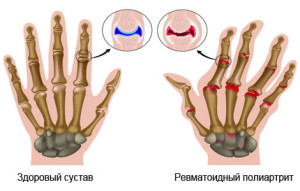 як лікувати ревматизм ніг у дітей