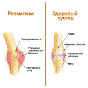 як лікувати ревматизм ніг у дітей