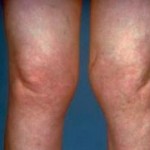 як лікувати ревматизм колін