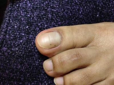 синяк ніготь палець нога рука лікування