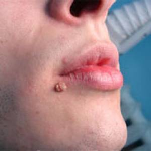 бородавки на губі типи діагностика лікування