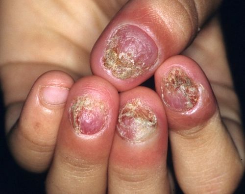 вилікувати грибок нігтів без таблеток
