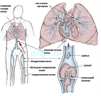 тромбоемболія легеневої артерії