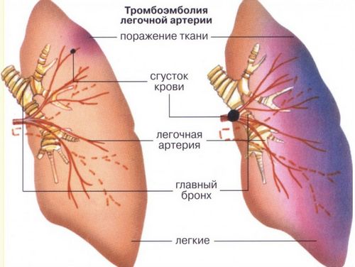 як лікувати тромбоемболії легенів