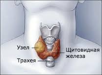вузловий зоб щитовидна залоза симптоми лікування