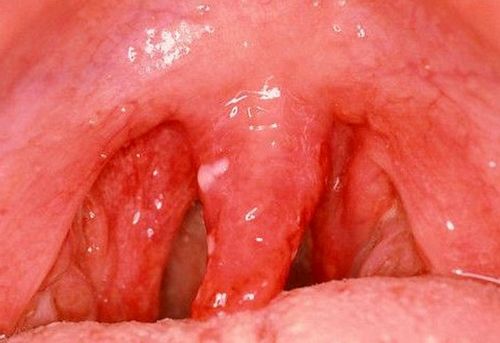 як лікувати хламідії в горлі