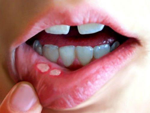 виразковий стоматит дітей лікування симптоми причини лікувати ерозивно профілактика гігієна виразки рот дитини дієта полоскати