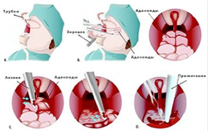 аденоїди діти причини різновиди ступеня симптоми ускладнення діагностика лікування профілактика операція народні методи