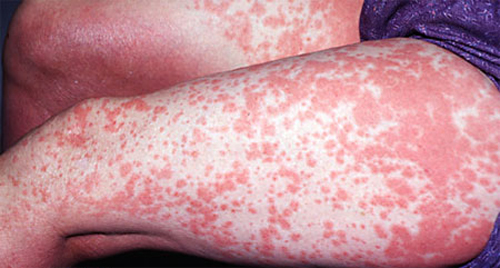 алергічний дерматит на руках